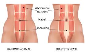 Diastasi addominale